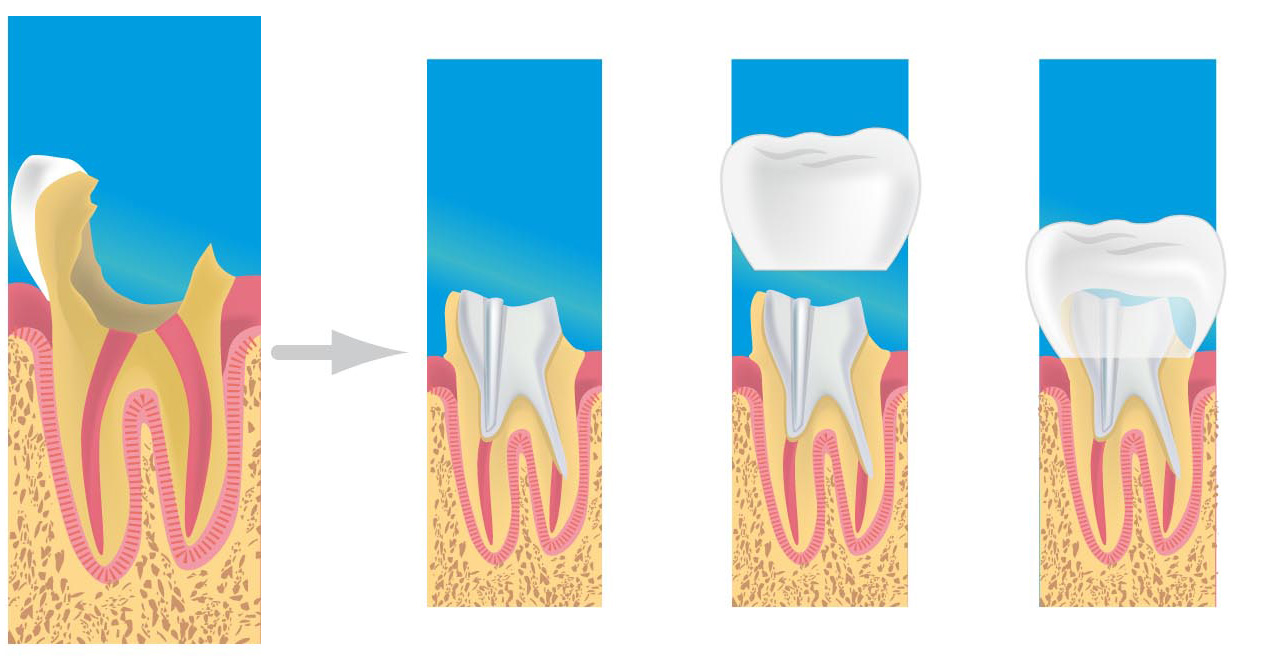 couronne dentiste montigny le bretonneux