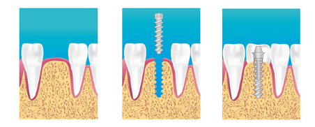 implants dentaires montigny